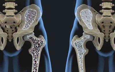 Conociendo la osteoporosis