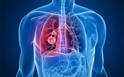 Enfermedad-pulmonar-obstructiva-cronica-EPOC-Bases-para-el-medico-general