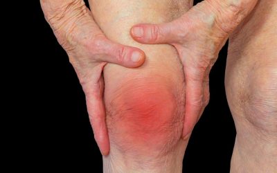 Artritis reumatoide diagnostico evolucion y tratamiento